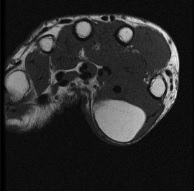 Lipomatous Tumours, t1 weighted mri of an intramuscular lipoma of the thenar muscles