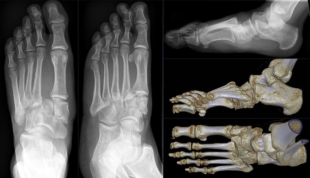 Lisfranc Fracture / Dislocations, radiograph and ct reconstruction of a lisfranc fracture dislocation