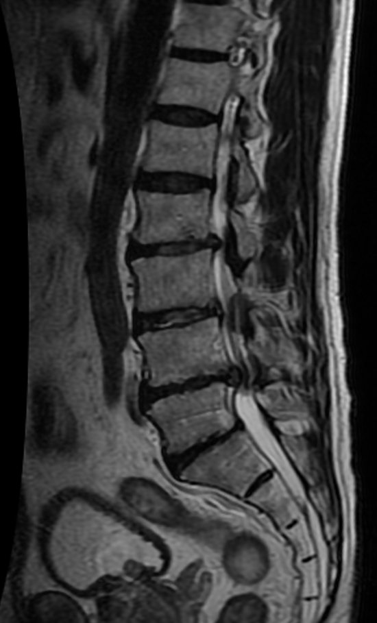 Lumbar Canal Stenosis, sagittal mri of lumbar spinal stenosis