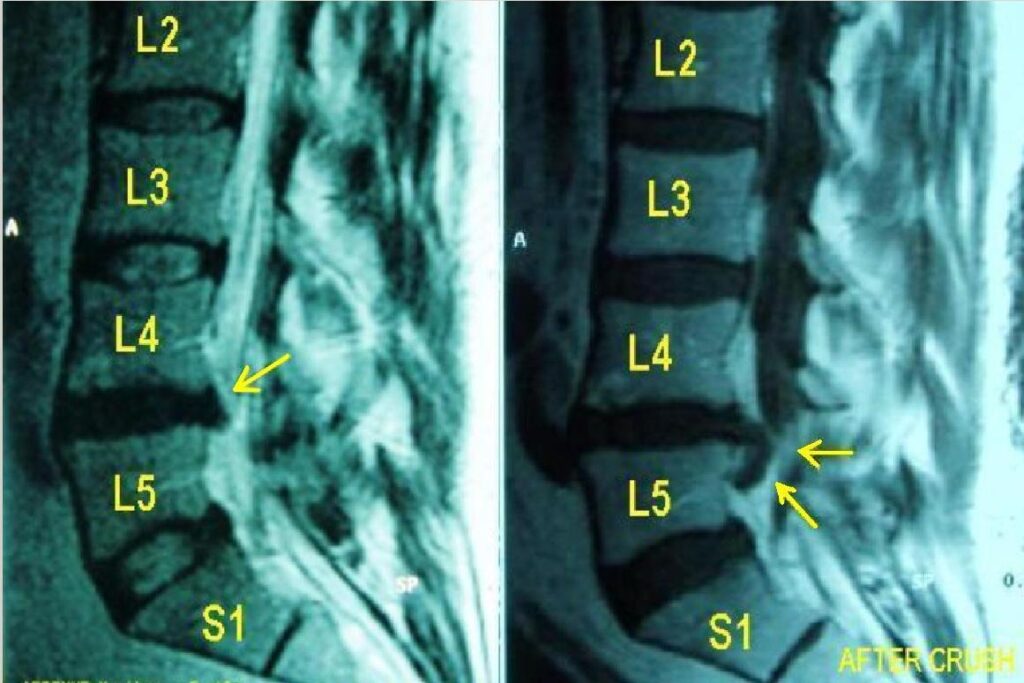 Spine iSAWE 14, sagittal T2 MRI of the lumbar spine