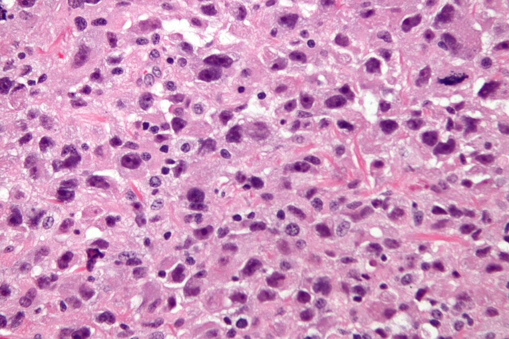 Malignant Fibrous Histiocytoma, histology of undifferentiated pleomorphic sarcoma, formerly called malignant fibrous histiocytoma