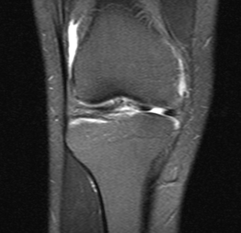Meniscal Injuries, mri of a meniscal tear
