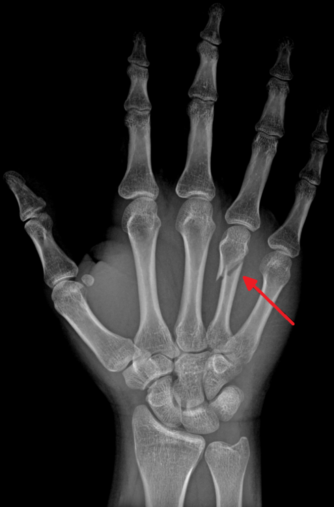 Hand iSAWE 7, radiograph of the hand
