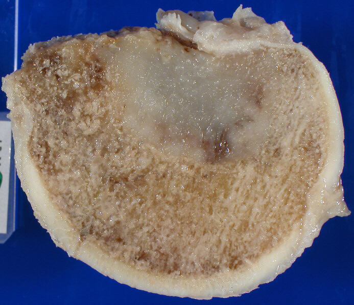 Metastatic Tumours, femoral head with bone metastasis