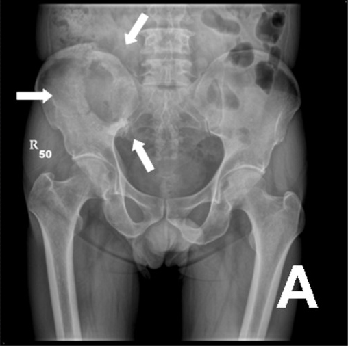 Metastatic Tumours, pelvic radiograph showing bone metastases