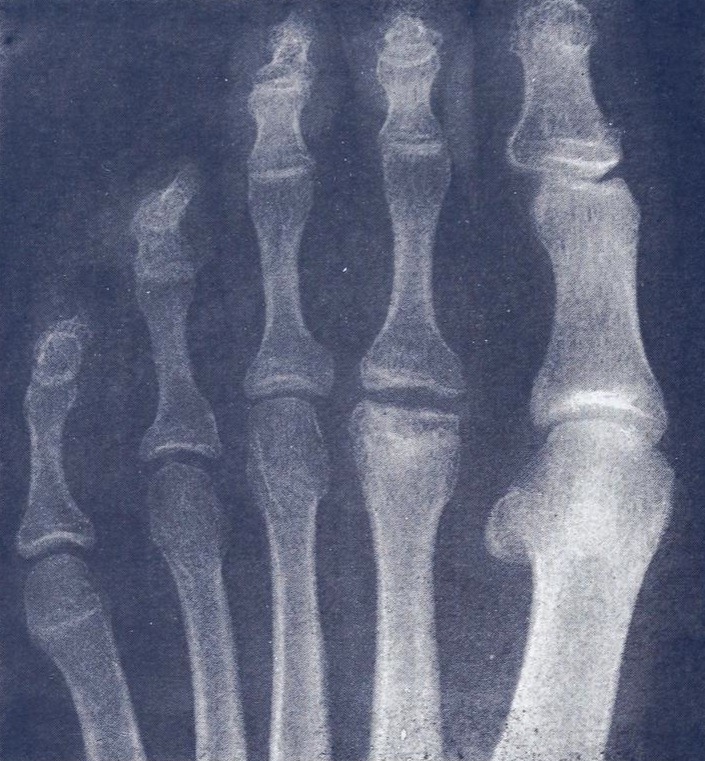 Foot Ankle iSAWE 10, ap radiograph of the foot