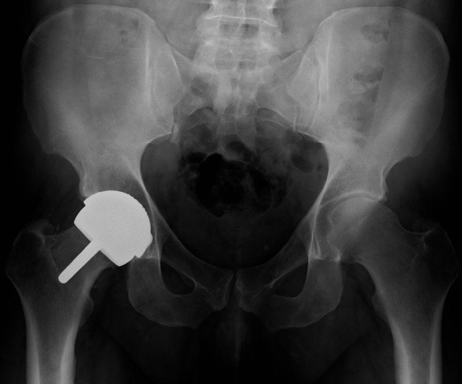 Arthroplasty iSAWE 2, ap radiograph of the pelvis