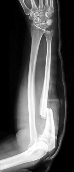 Monteggia Fracture, radiograph of a monteggia fracture