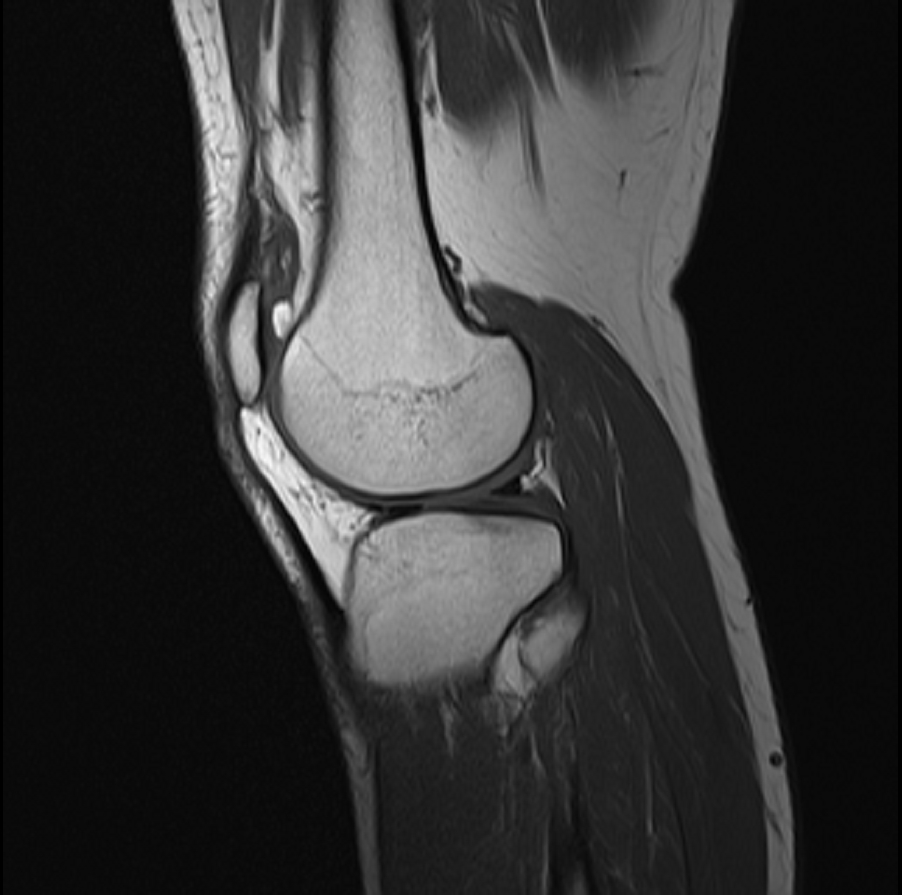 MRI, sagittal t1 weighted mri of the knee