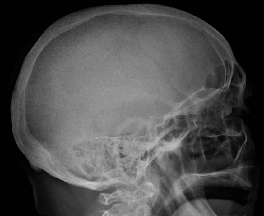 Tumour iSAWE 12, lateral radiograph of the skull