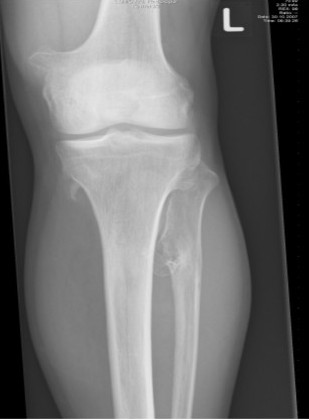 Paeds Elective iSAWE 11, radiograph of the knees