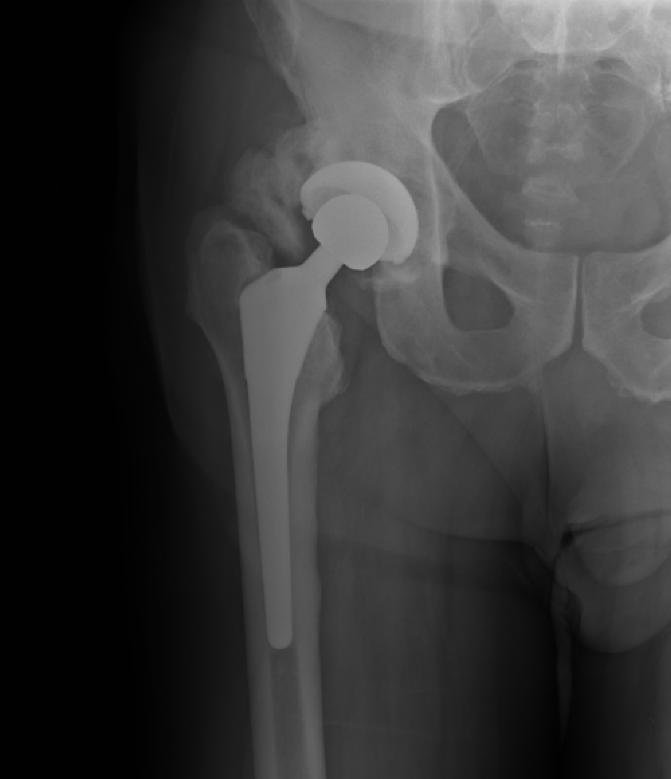 Arthroplasty iSAWE 3, ap radiograph of the hip