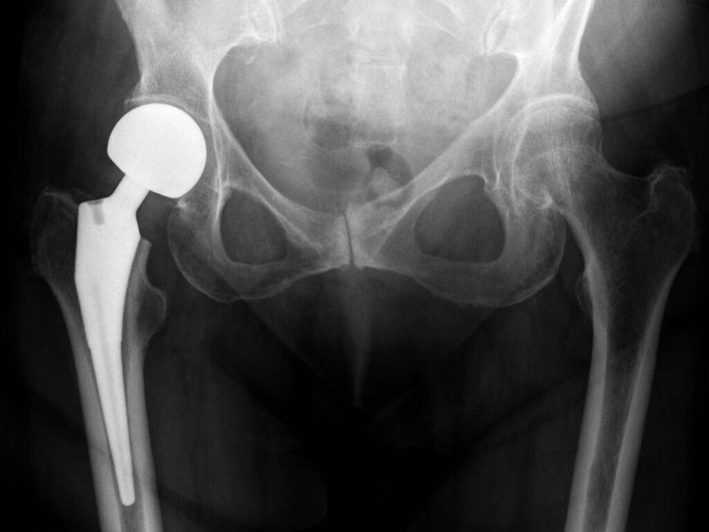 Neck of Femur Fractures, radiograph of the hips after hemiarthroplasty