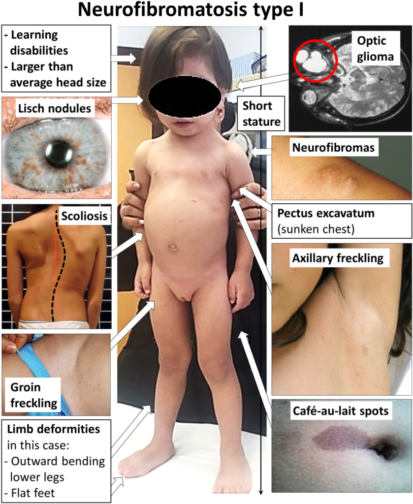 Neurofibromatosis, clinical features of neurofibromatosis type 1