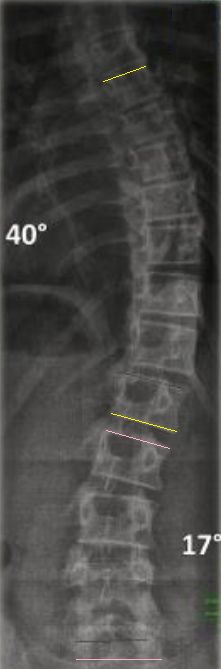 Neuromuscular Scoliosis, standing radiograph of a scoliosis with the cobb angle marked
