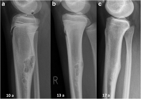 Non-ossifying Fibroma, radiograph of a non-ossifying fibroma