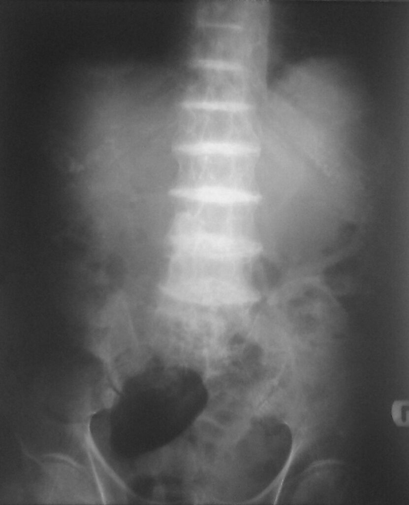 Ochronosis, radiograph showing calcification of the intervertebral discs in ochronosis