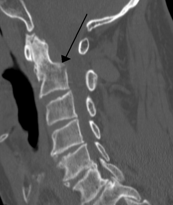 Spine iSAWE 8, sagittal ct of the cervical spine