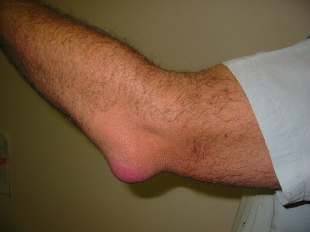 Olecranon and Prepatellar Bursitis, olecranon bursitis