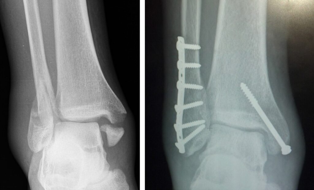Open Reduction Internal Fixation, trimalleolar ankle fracture before and after open reduction and internal fixation