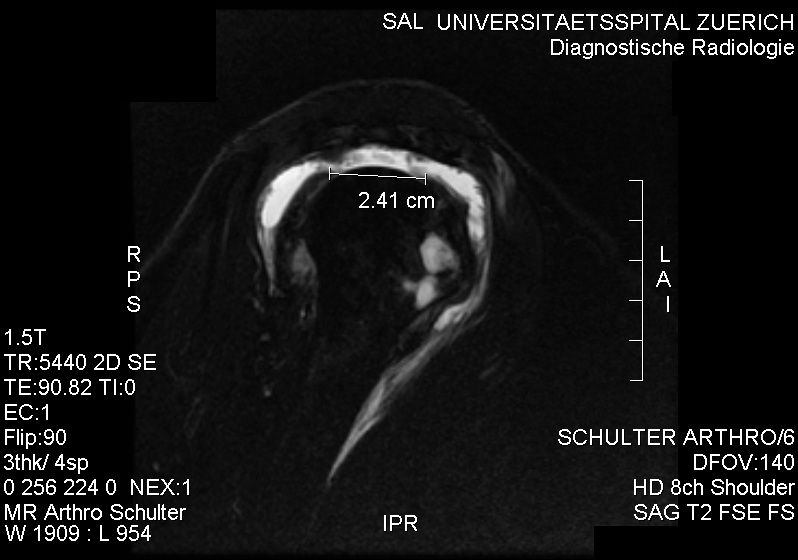 Open Rotator Cuff Repair, mri of a complete supraspinatus tear