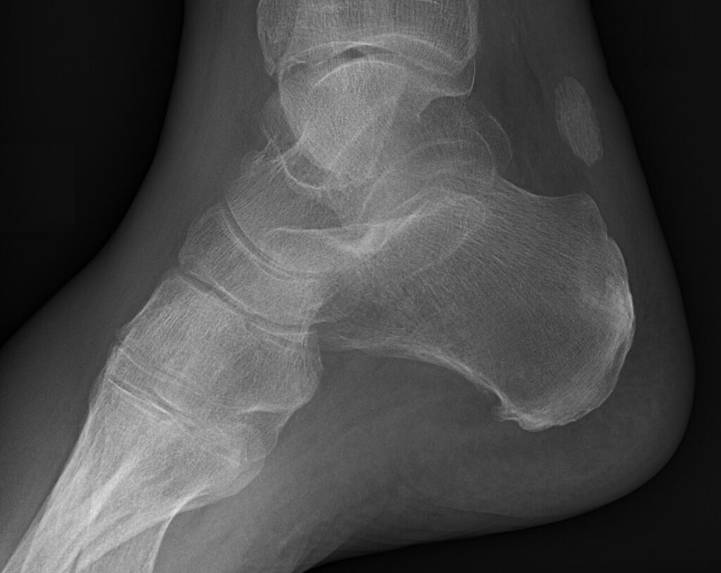 ORIF Calcaneum, lateral radiograph of a calcaneal fracture