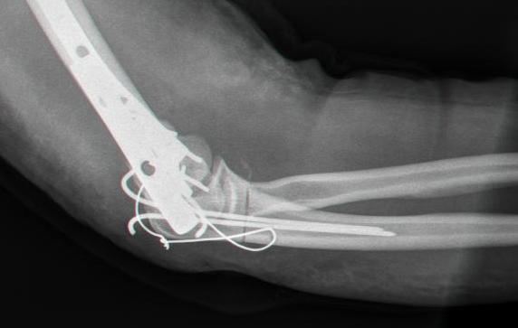 Shoulder Elbow iSAWE 15, lateral radiograph of the elbow after fixation