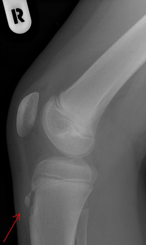 Paeds Elective iSAWE 20, lateral radiograph of the knee