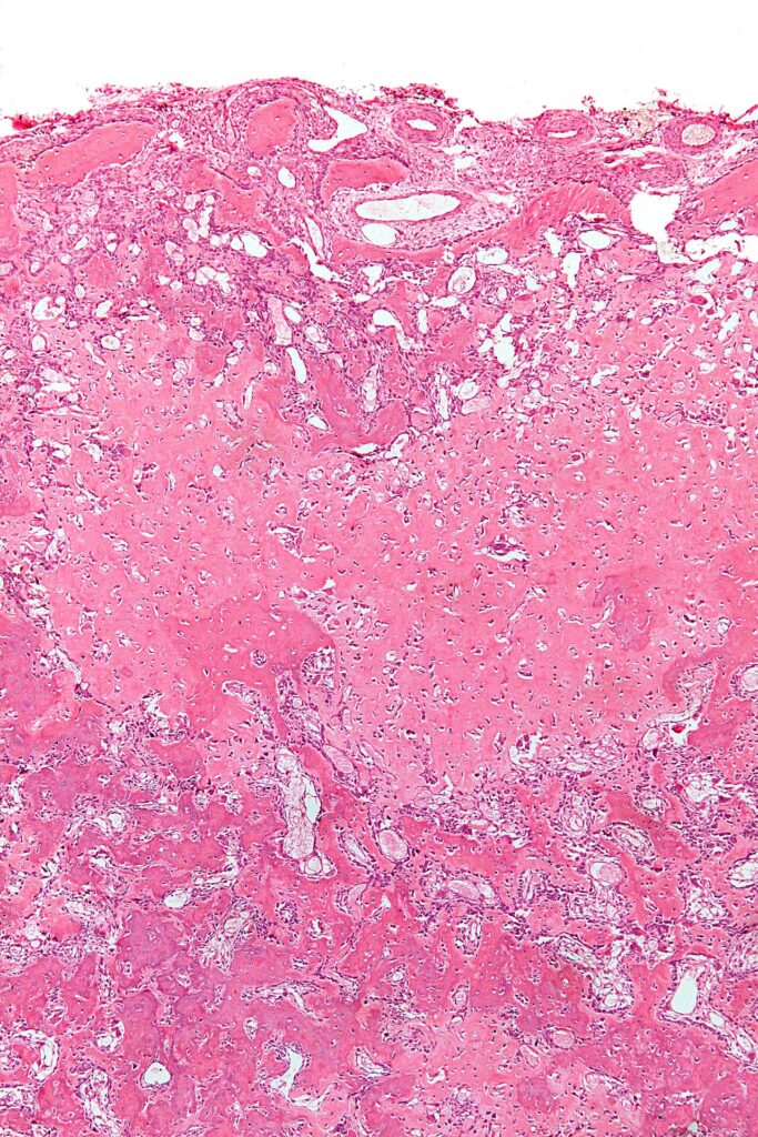 Osteoblastoma, histology of osteoblastoma at low magnification