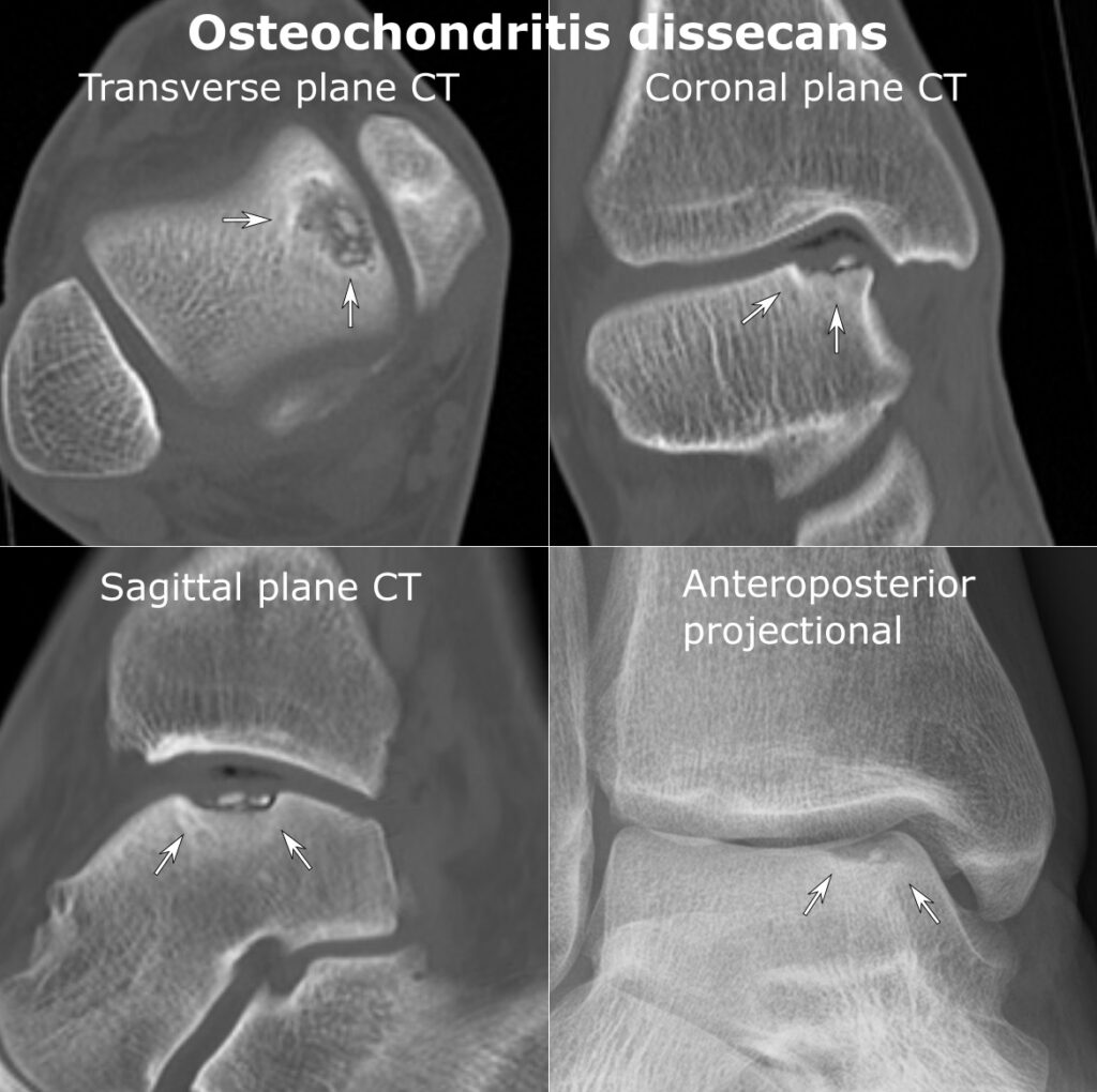 Osteochondritis Dissecans (OCD) of the Talus, ct and radiograph of osteochondritis dissecans of the talus