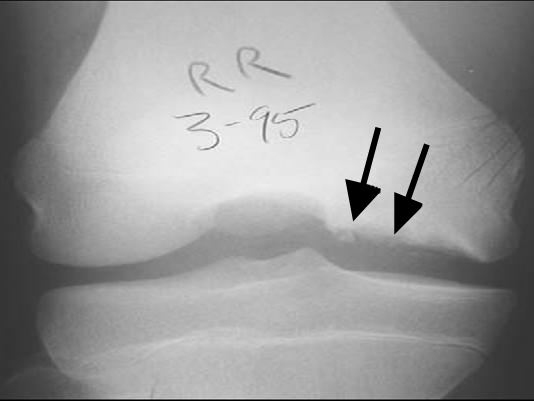 Knee iSAWE 10, ap radiograph of the knee