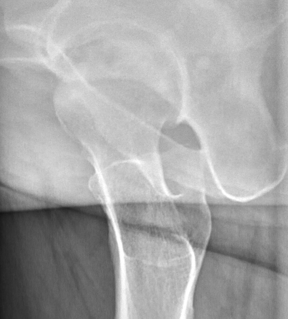 Osteonecrosis of the Hip | AVN, lateral radiograph of idiopathic avascular necrosis of the femoral head
