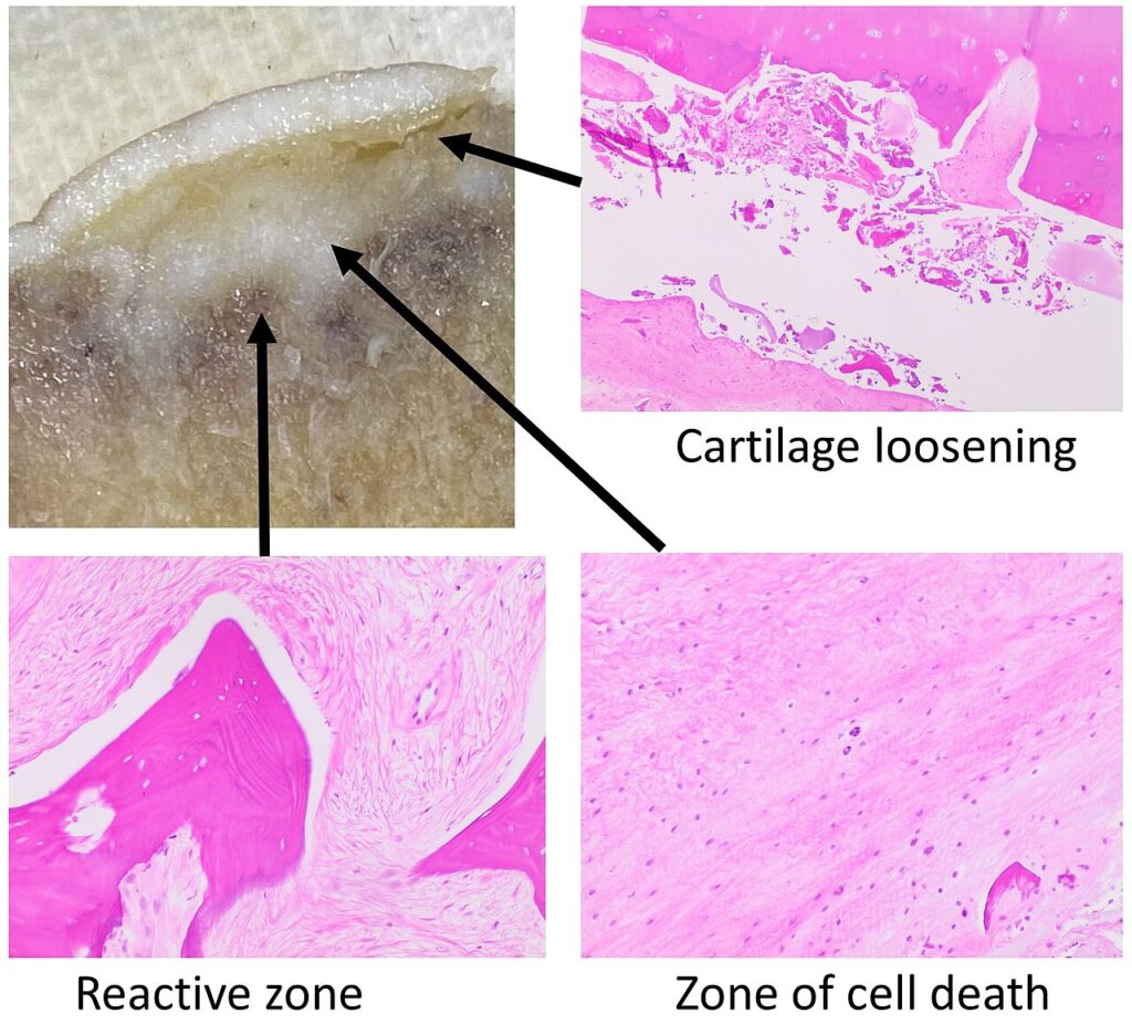 Osteonecrosis of the Hip | AVN, pathology of avascular necrosis of the femoral head, showing the zone of cell death beneath the articular cartilage