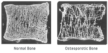 Osteoporosis - Role of the Surgeon, comparison of healthy and osteoporotic vertebral bone