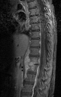 Paediatric Discitis, mri of discitis
