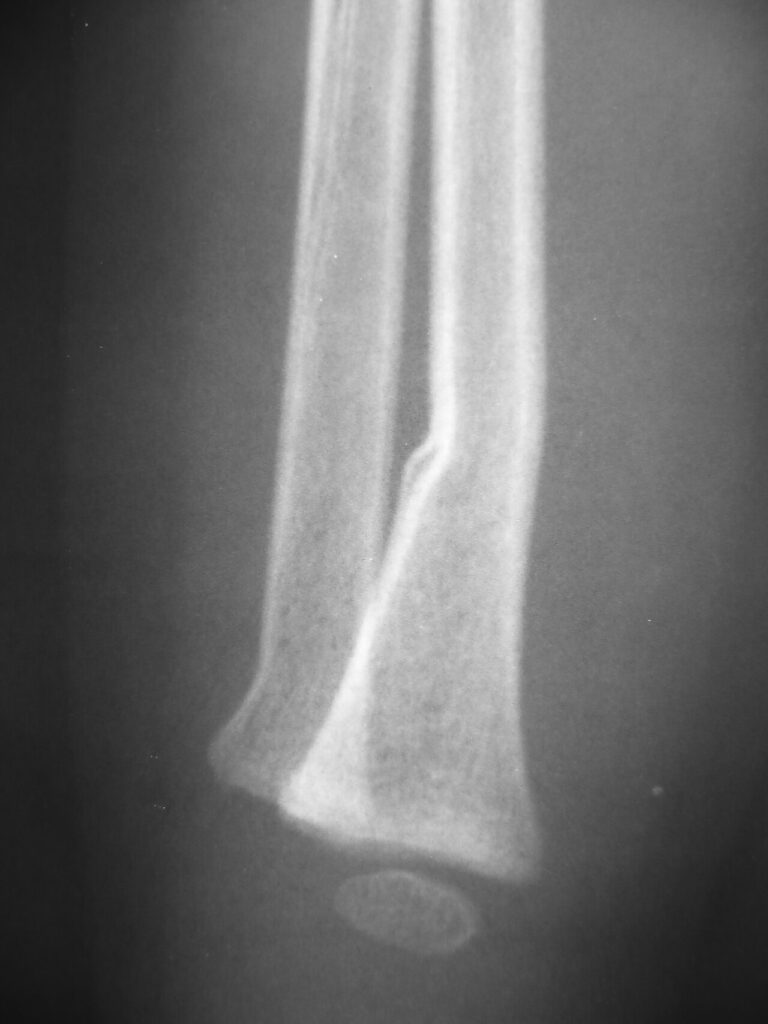 Paeds Trauma iSAWE 11, lateral radiograph of the distal forearm