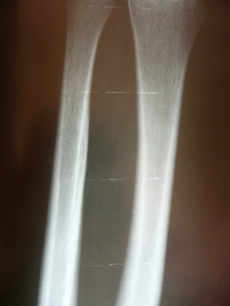 Paediatric Forearm Fracture & Dislocations, radiograph of a forearm fracture
