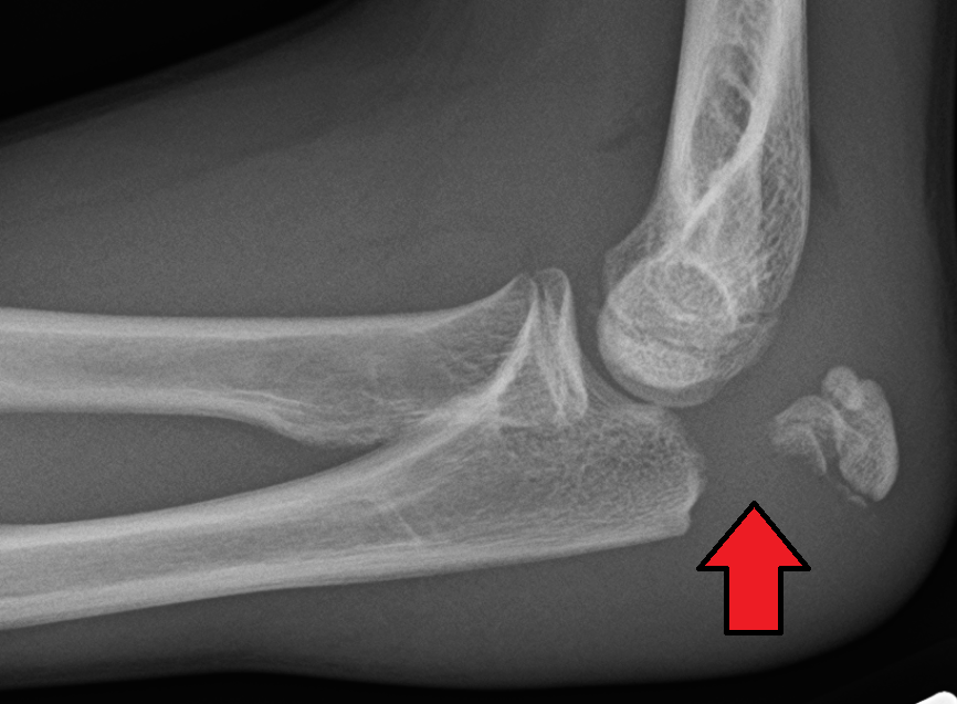 Paeds Trauma iSAWE 14, lateral radiograph of the elbow