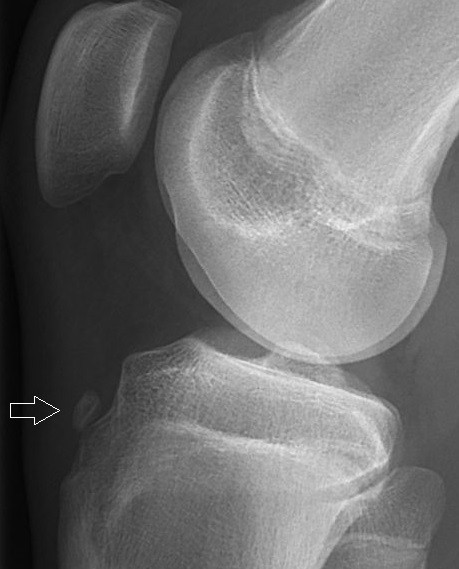 Paeds Trauma iSAWE 12, lateral radiograph of the knee