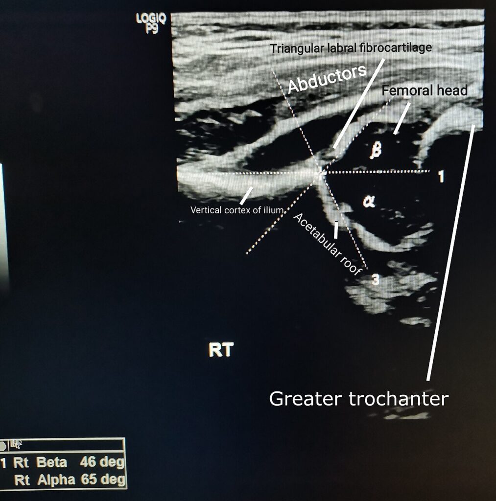Paeds Elective iSAWE 1, hip ultrasound with graf angles