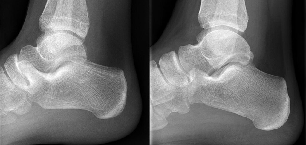Paeds Elective iSAWE 10, lateral radiographs of the foot