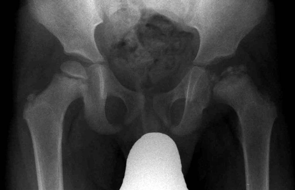 Paeds Elective iSAWE 2, ap pelvis radiograph
