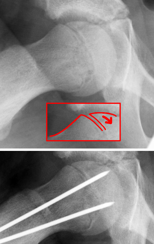 Paeds Elective iSAWE 3, radiographs of the hip