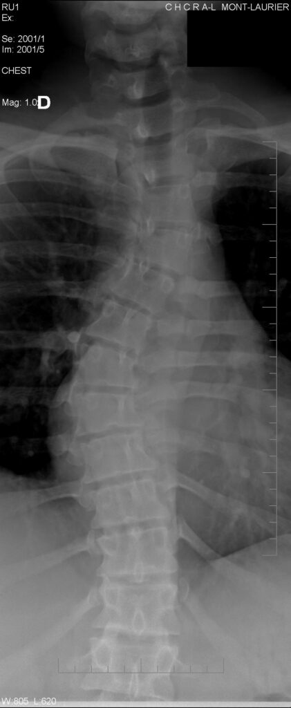 Paeds Elective iSAWE 6, standing radiograph of the spine