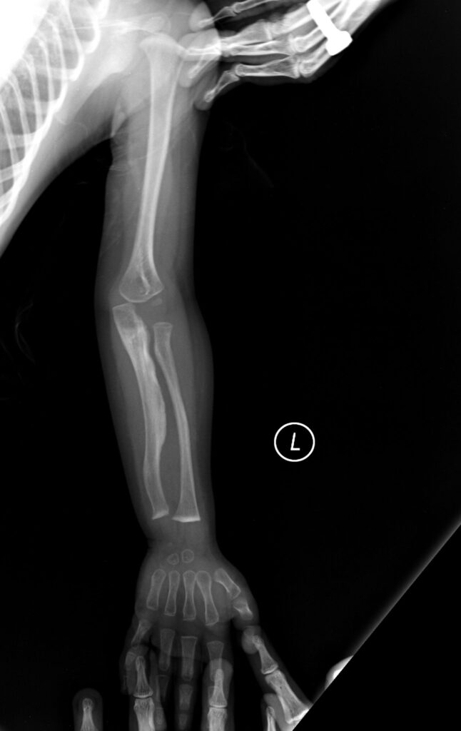 Paeds Elective iSAWE 9, radiograph of the upper limb