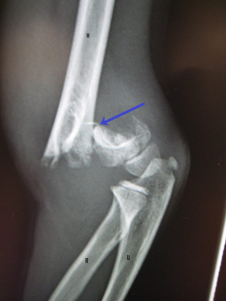Paeds Trauma iSAWE 1, lateral radiograph of the elbow