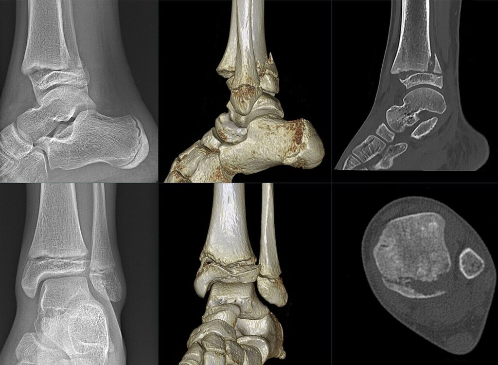 Paeds Trauma iSAWE 16, radiographs and CT of the ankle