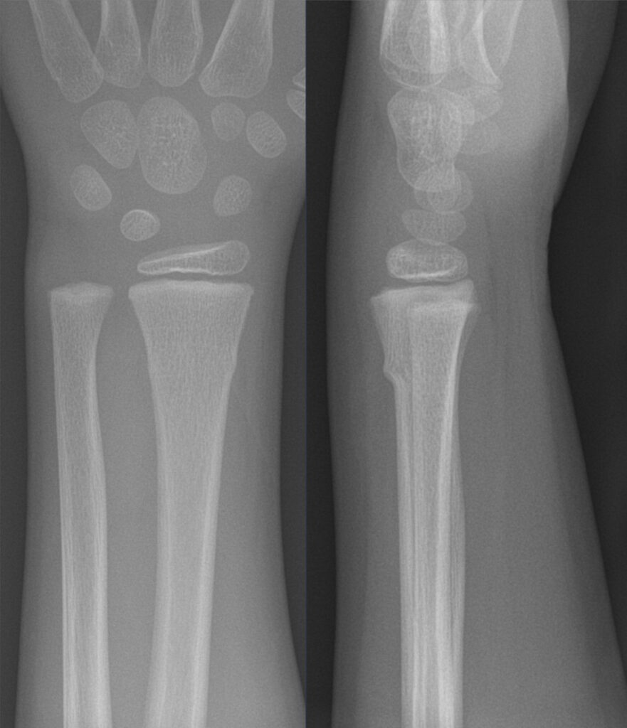 Paeds Trauma iSAWE 17, AP and lateral radiographs of the wrist