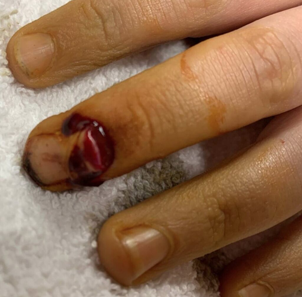 Paeds Trauma iSAWE 18, clinical photograph of the finger