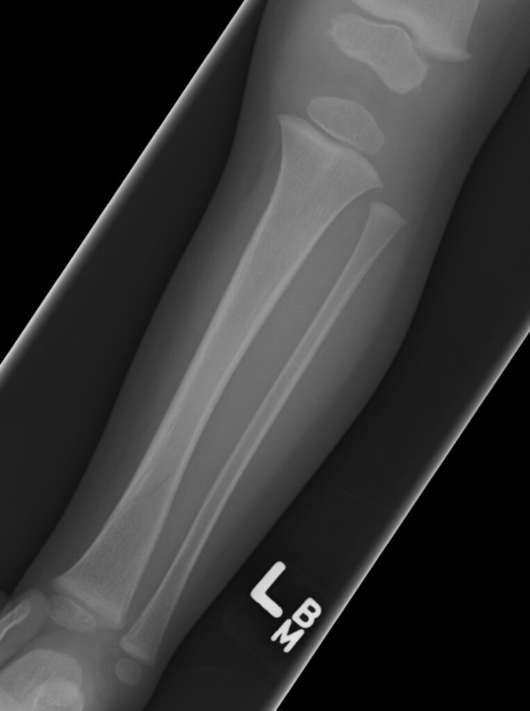Paeds Trauma iSAWE 19, AP radiograph of the tibia and fibula